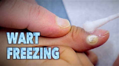 Occasionally if the lesion is very thick (such as a large <b>wart</b>), only the surface is blistered <b>off</b>. . Stages of a wart falling off after freezing
